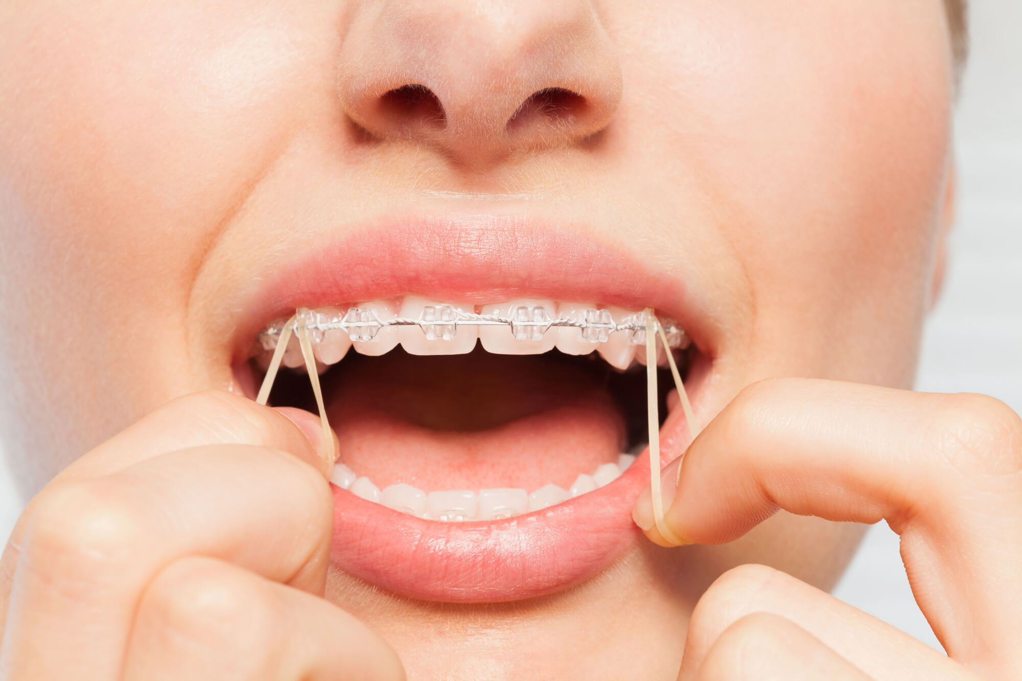 Person with clear braces pulls on bands attached to top teeth brackets