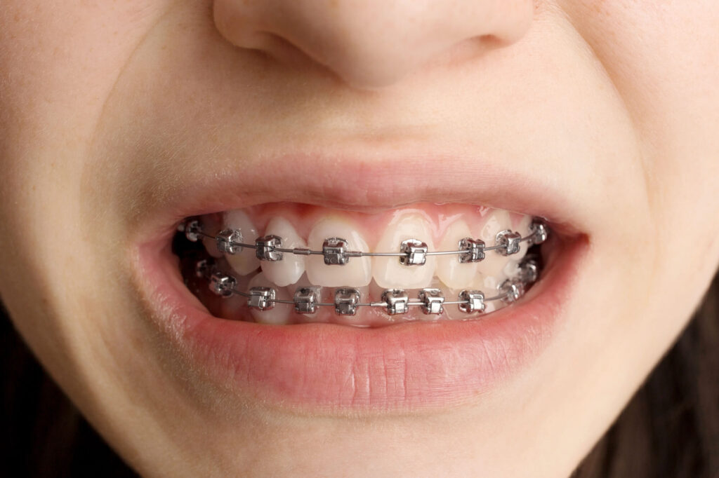 Patient wearing metal braces smiles