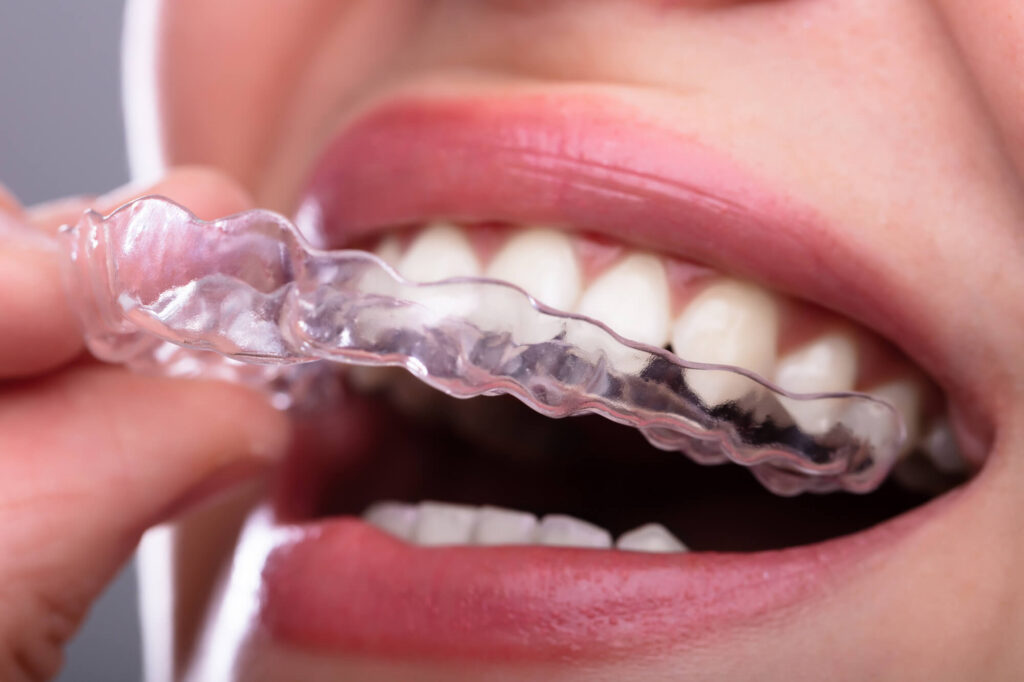 Woman places clear aligner on top teeth