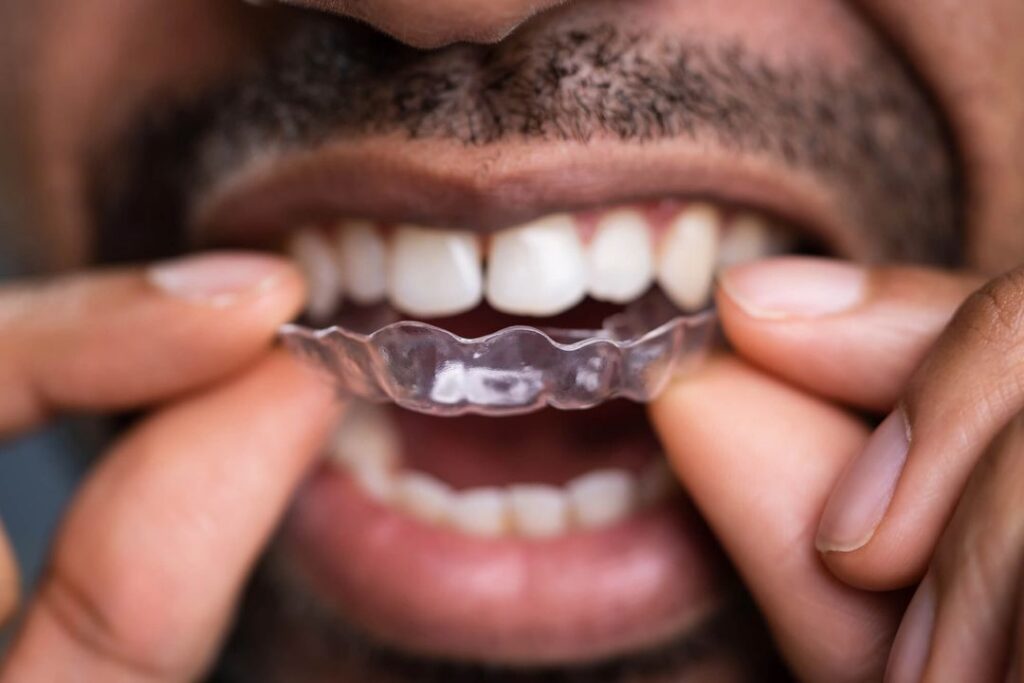 Man with facial hair places clear aligner on top teeth