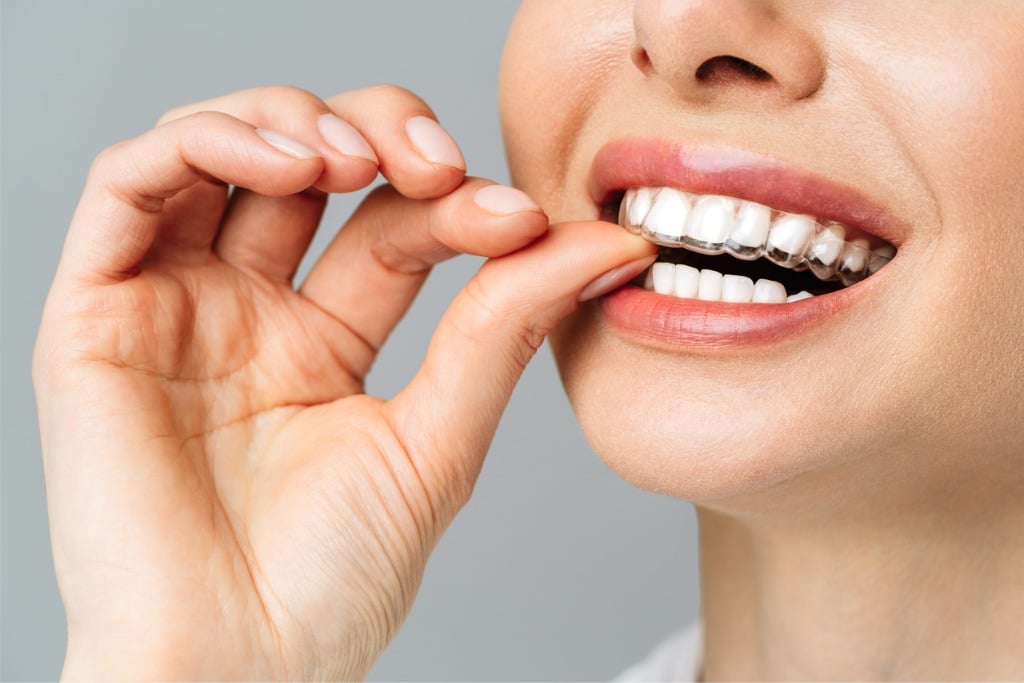 A Woman Inserting Retainers