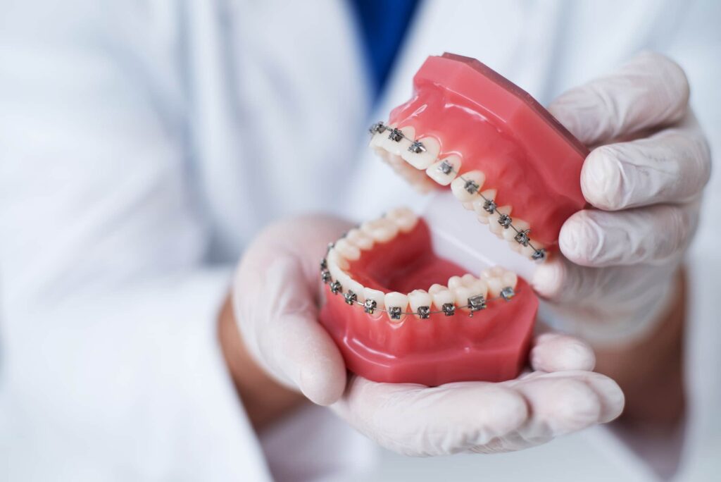 Braces 1
