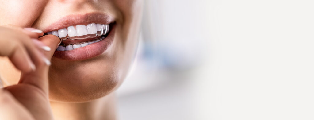 A Woman Puts On An Invisible Silicone Teeth Aligner Dental Braces For Teeth Correction 1433819212 11437x4371 1